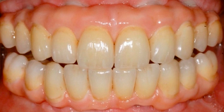 A Novel Approach to Implant Screw-Retained Restorations