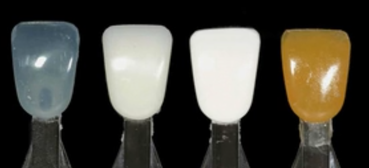Challenging Composite Restoration With Free-Hand-Bonding: An Illusion Became Re