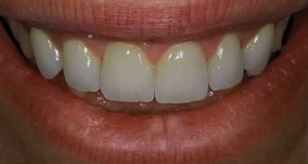 Clinical elements in achieving natural implant aesthetics