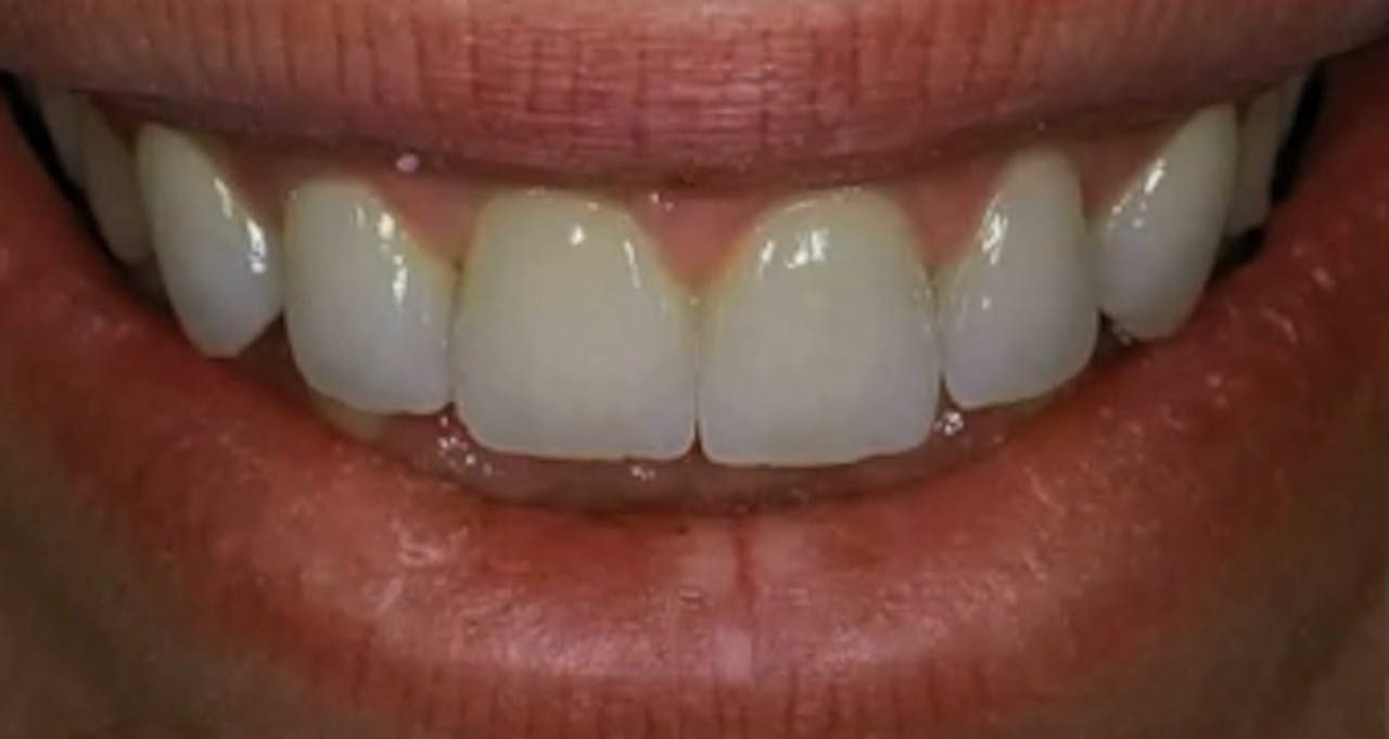 Clinical elements in achieving natural implant aesthetics gIDE Dental