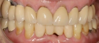 CLINICAL VIDEO Sinus Bone Augmentation with rhBMP-2/bone filler and Implant Plac