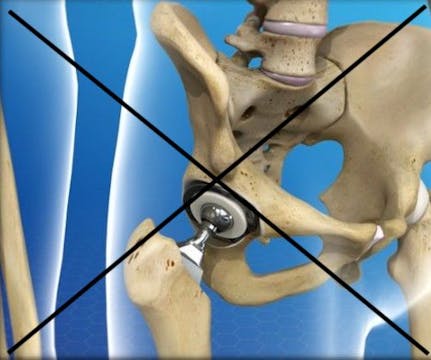 How to Avoid a Hip Replacement #1