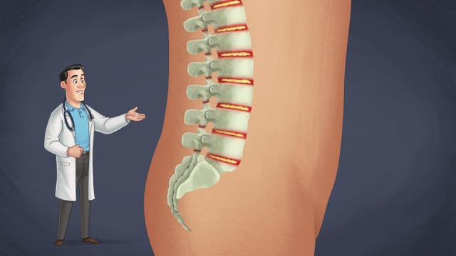 Ankylosing spondylitis - Learn more