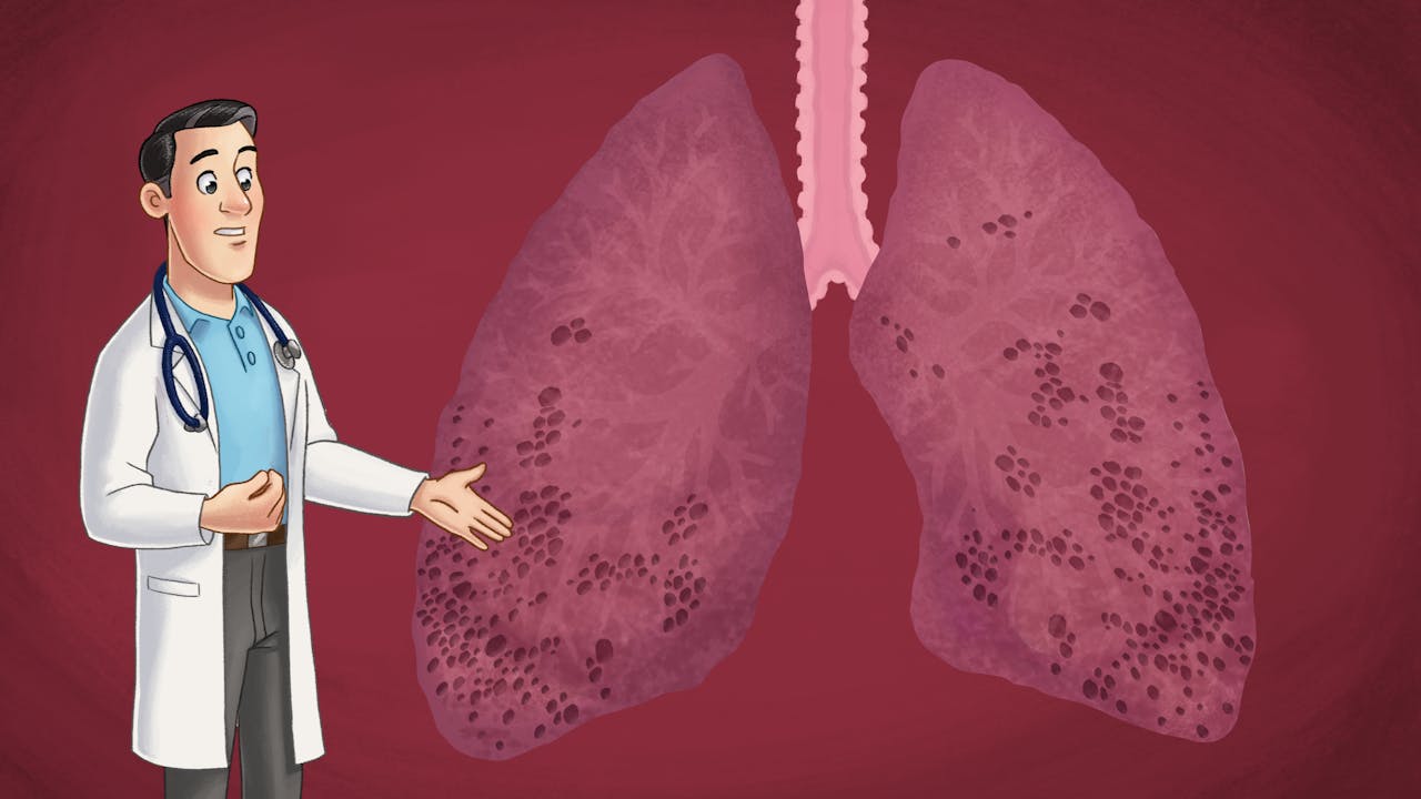 Interstitial lung disease