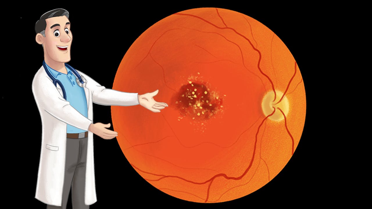 Macular degeneration