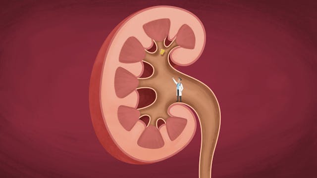 Kidney stones - Learn more