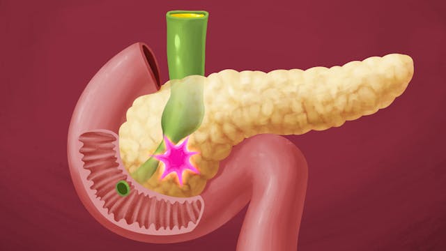 Pancreatic cancer - Learn more