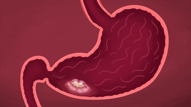 Stomach cancer - Learn more