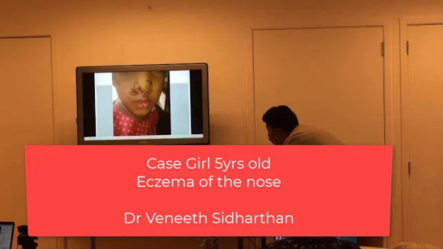 Veneeth course I – Part 8 A girl with eczema on the nose