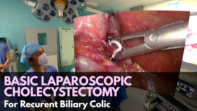 Basic Laparoscopic Cholecystectomy