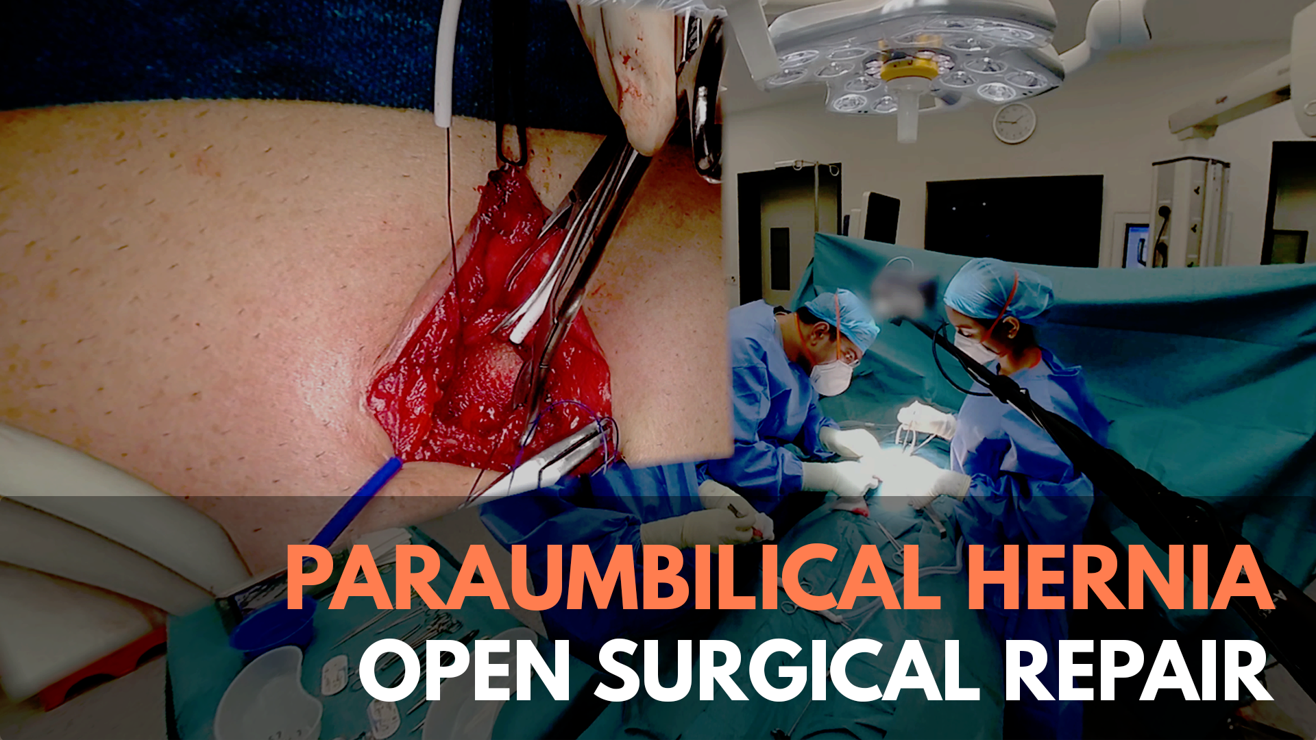 Paraumbilical Hernia Open Surgical Repair