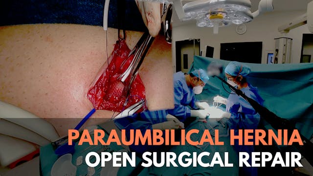 Paraumbilical Hernia Open Surgical Repair