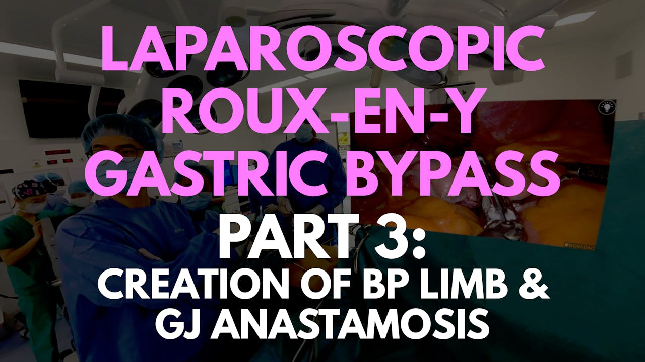 Laparoscopic Roux-en-Y Gastric Bypass Part 3: Creation of BP Limb/GJ ...