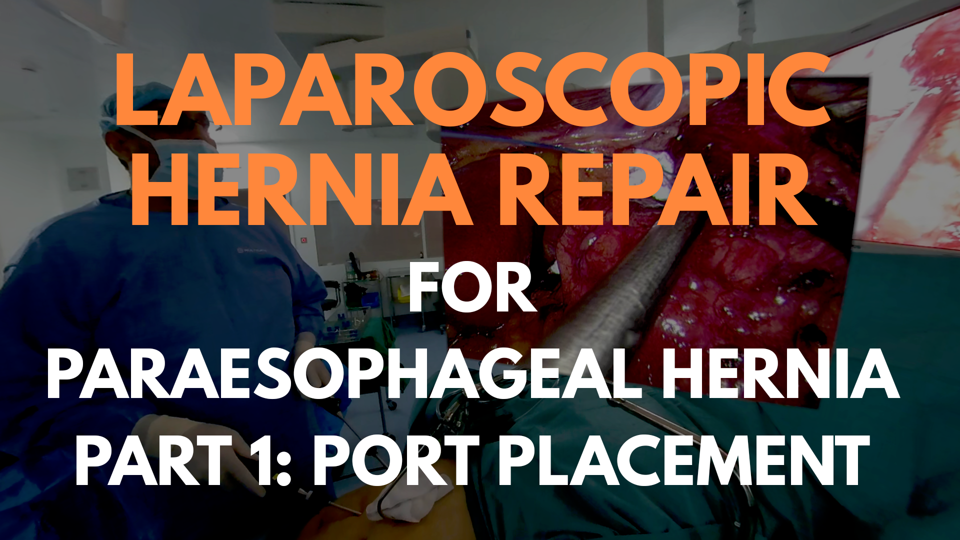 Laparoscopic Hernia Repair For Paraesophageal Hernia Part 1: Port ...