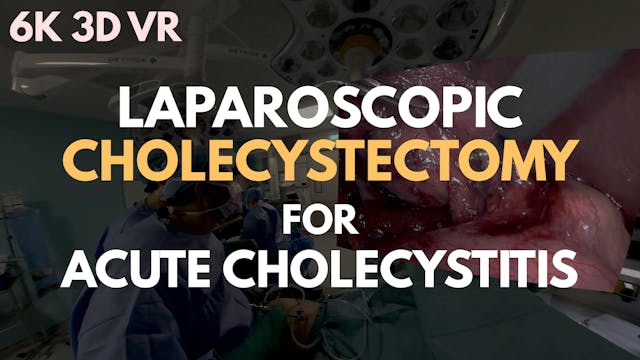 Basic Laparoscopic Surgery: Cholecystectomy