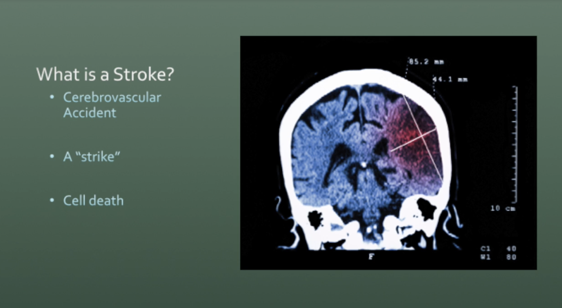 Stroke Workshop Introduction