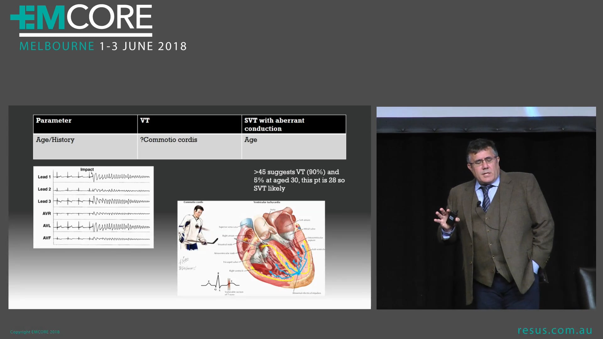 VT or not VT That is the question Dr Will Davies