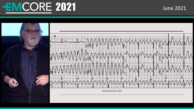 3 ECGs Artifact, Lead Reversal and K+...