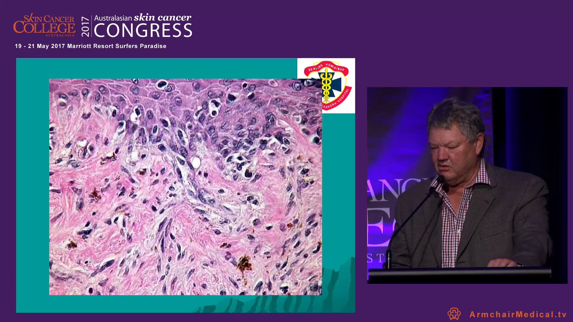Ajuvant radiotherapy for squamous and basal cell carcinoma - When to refer Prof Bryan Burmeister