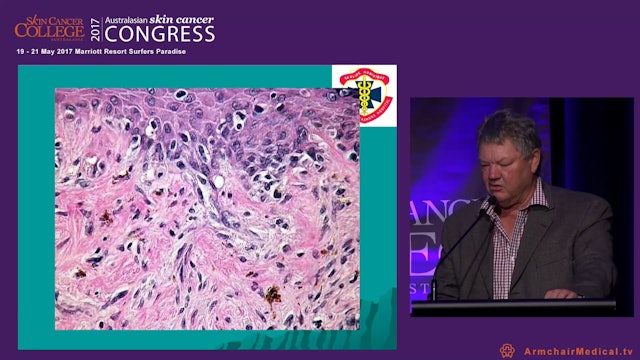 Ajuvant radiotherapy for squamous and basal cell carcinoma - When to refer Prof Bryan Burmeister