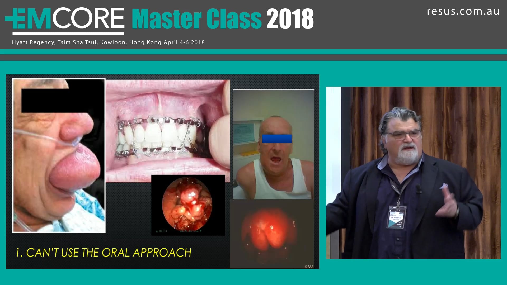 Awake Intubation Assoc Prof Peter Kas