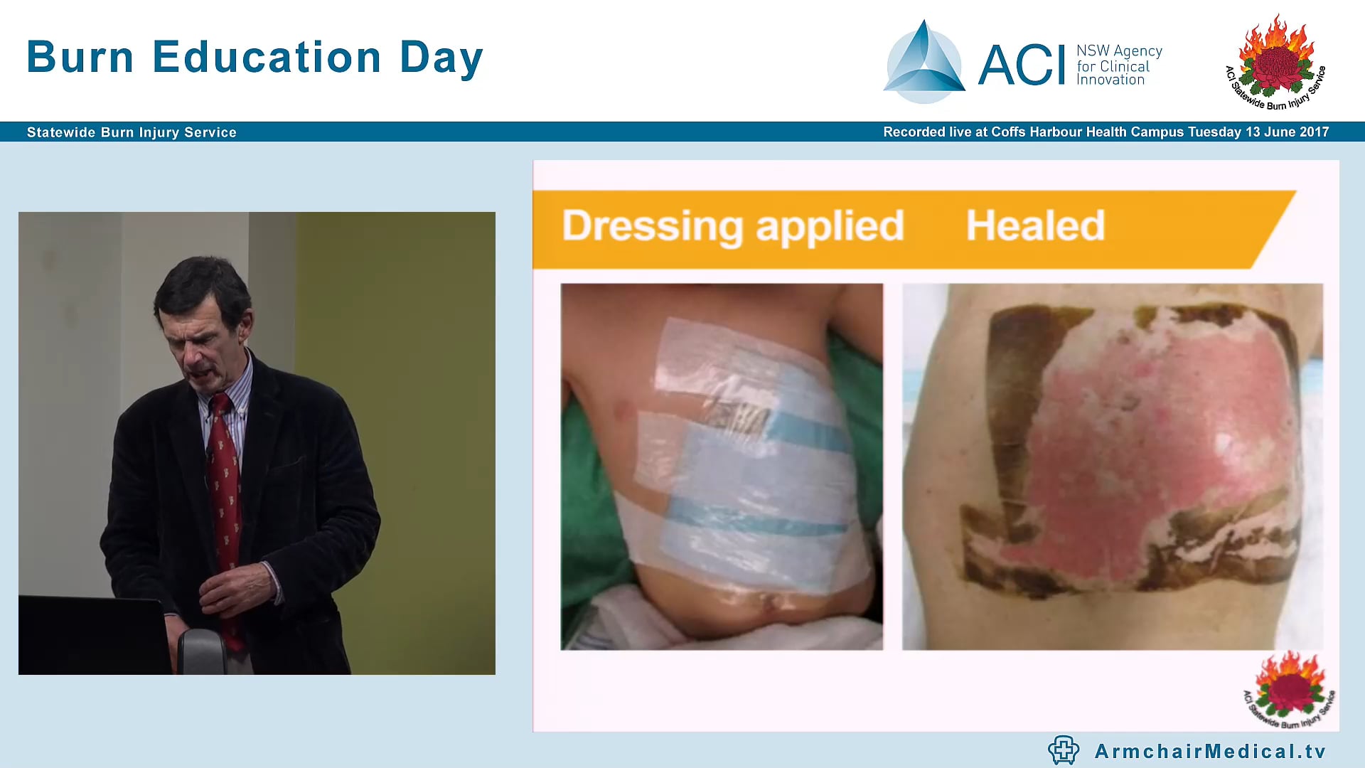 Management of Burns Conservative, Operative, Negative Pressure, Biobrane, Dr John Harvey, Paediatric Surgeon & Director Burn Unit CHW