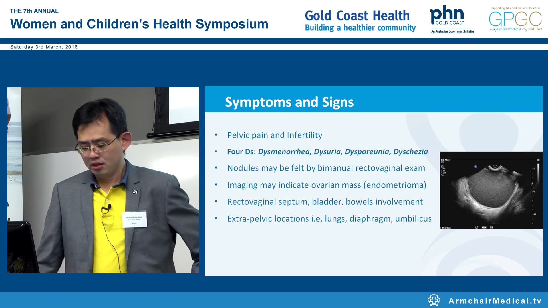 Endometriosis and chronic pelvic pain The modern woman’s perspective Dr Donald Angstetra