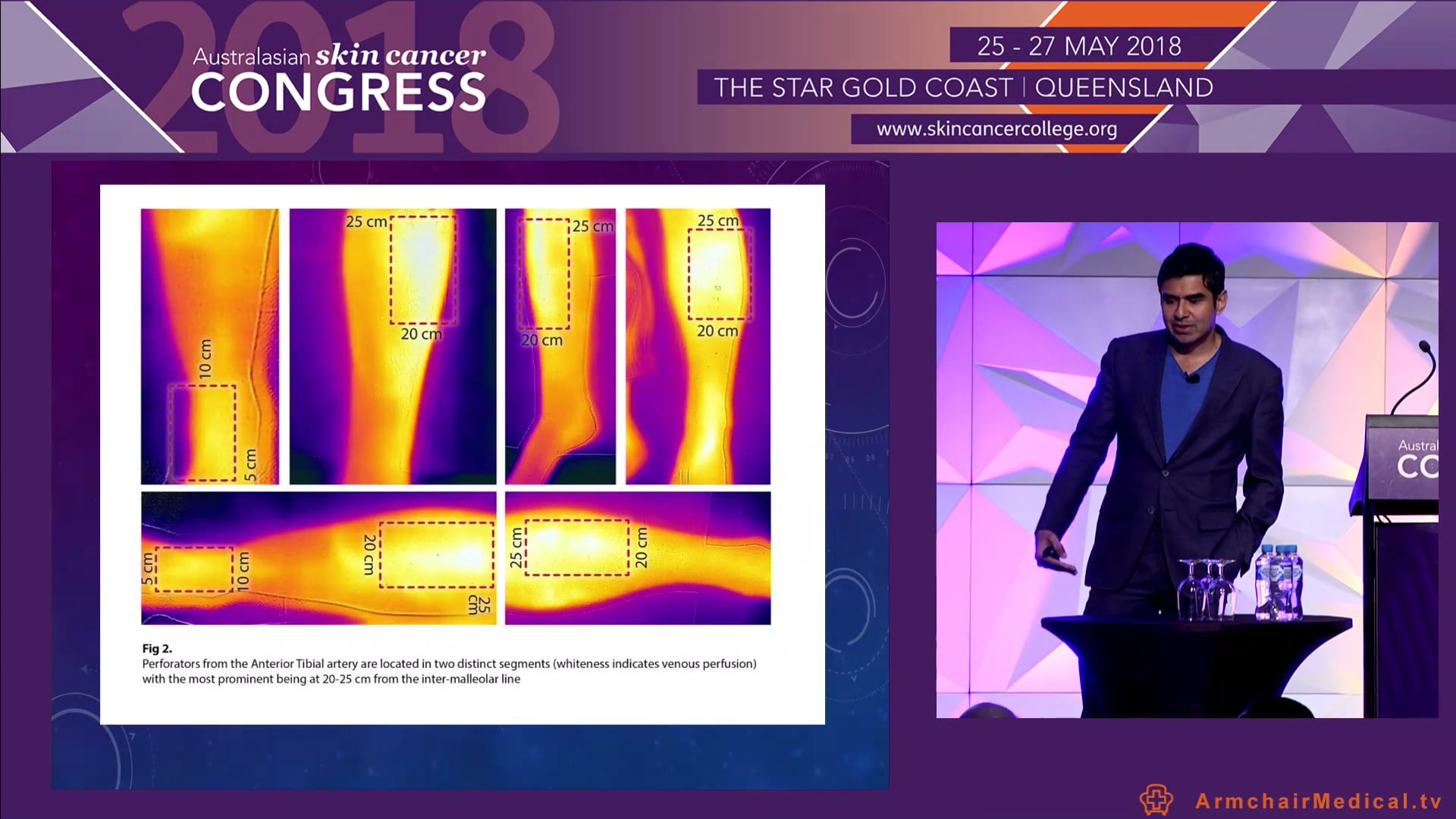 Surgical techniques Separation of skin components The Fascial Release Flap Dr Sharad P Paul