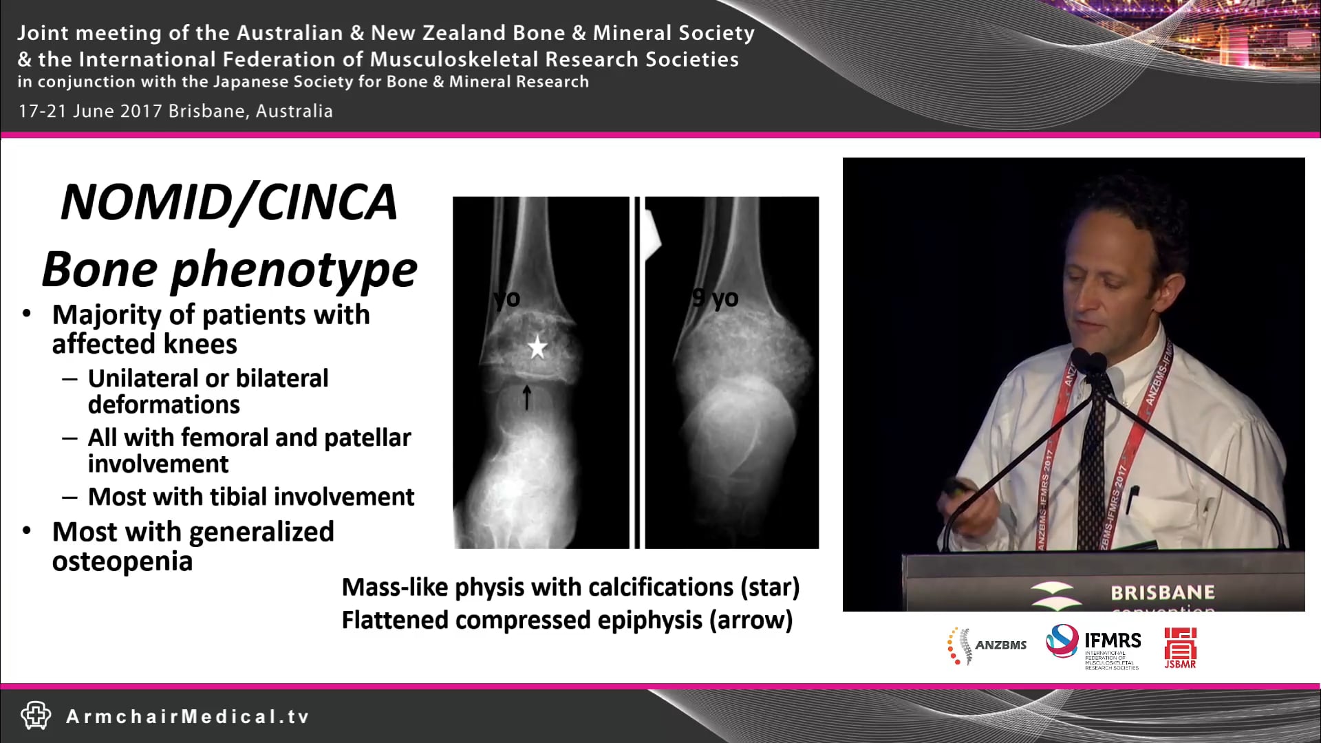 Mechanisms of inflammation and bone disease in CAPS Prof Hal Hoffman