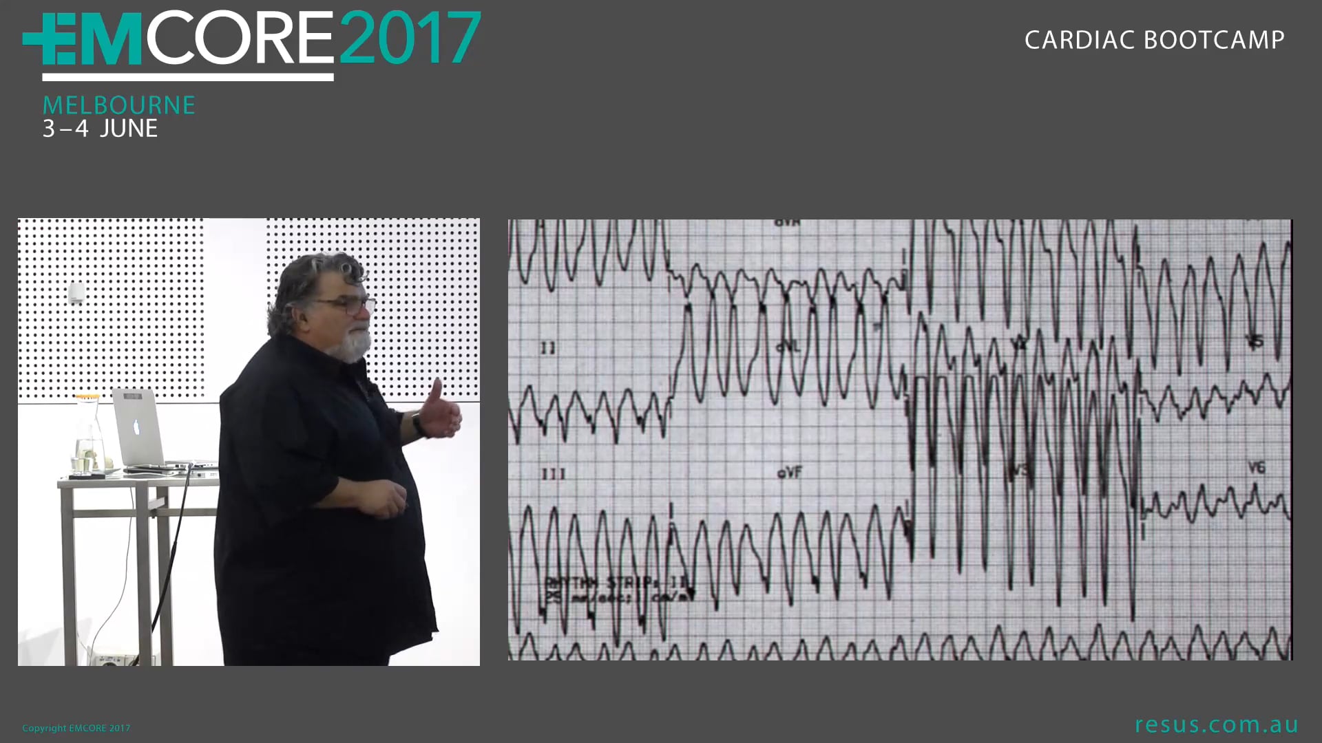 Brugada, Wellens, Dewinters, Spodick, WPW, Taketsubo, Bigeminy Assoc Prof Peter Kas