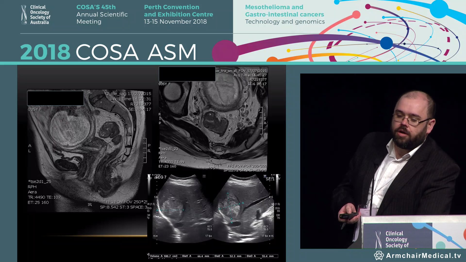 MDT panel discussion Management of colorectal cancer and concurrent liver mets