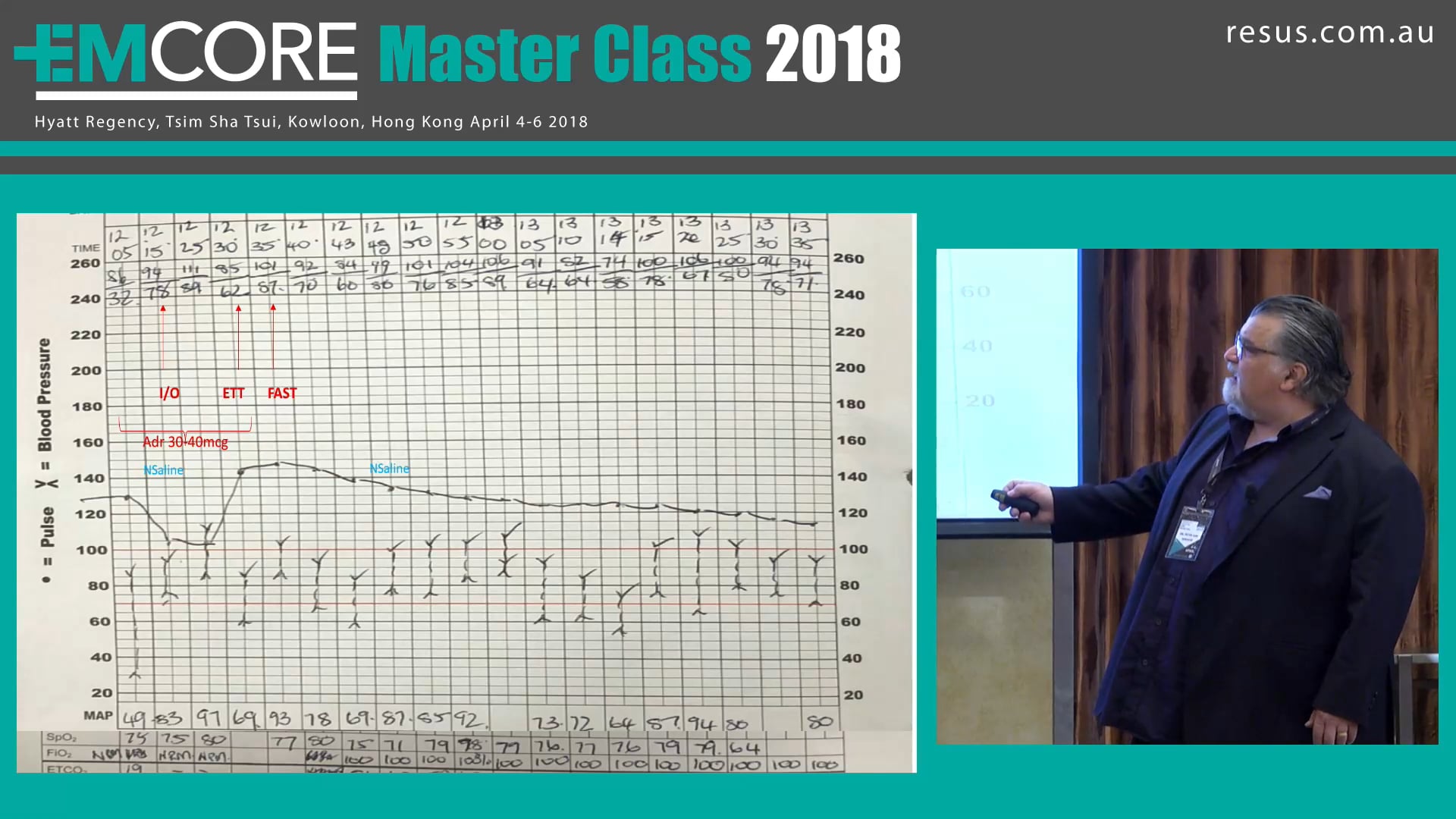 Neurogenic Stunned Myocardium Sepsis and AMI Assoc Prof Peter Kas