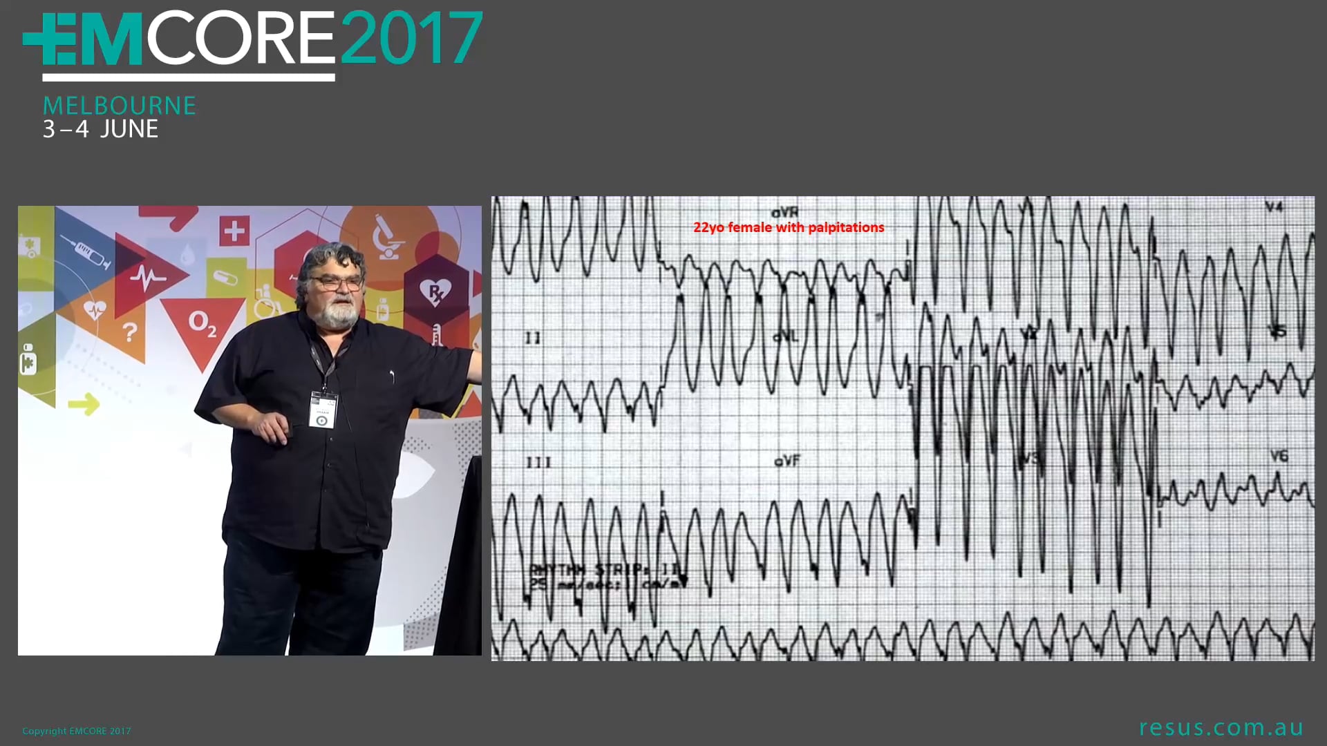 ECGs that can kill if you miss them Assoc Prof Peter Kas
