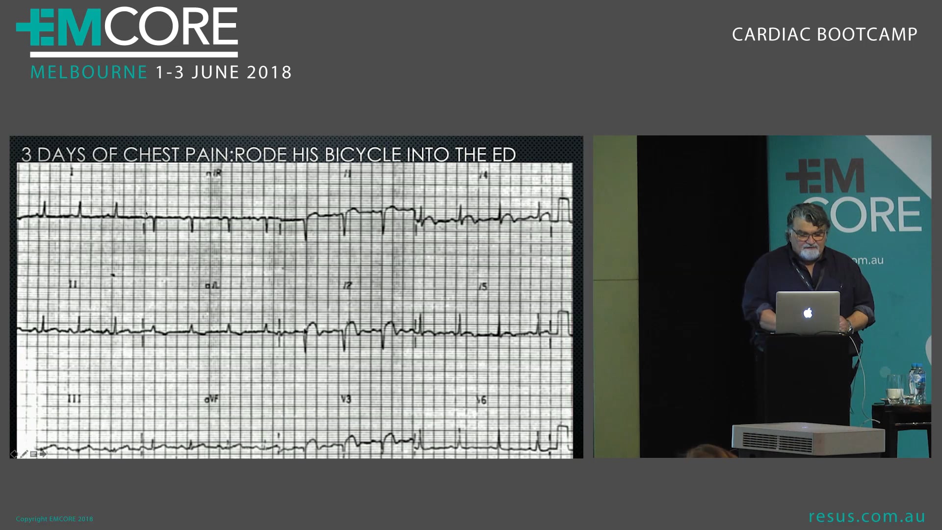 Subtle ischaemic changes Assoc Prof Peter Kas