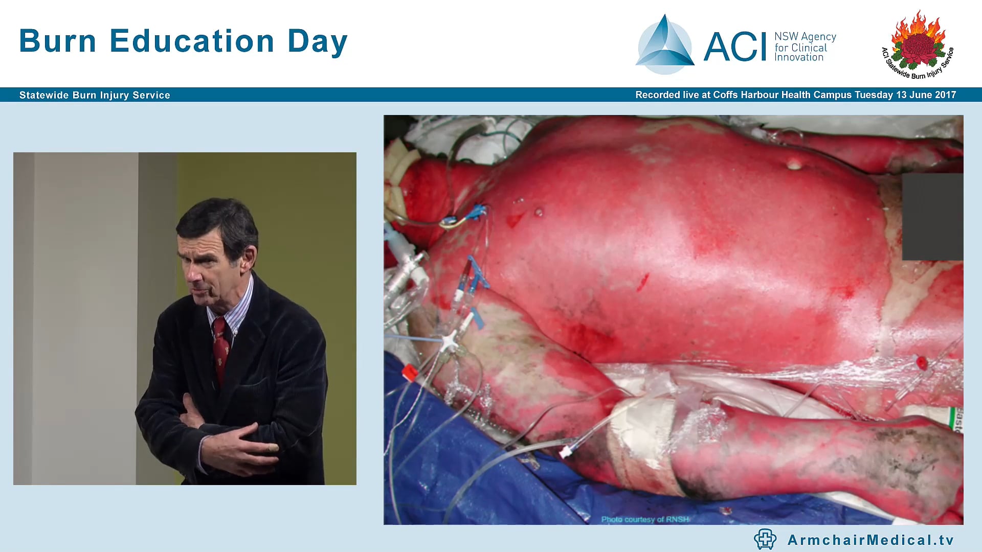 Burns Epidemiology, Response & Early Management Dr John Harvey, Paediatric Surgeon & Director Burn Unit CHW