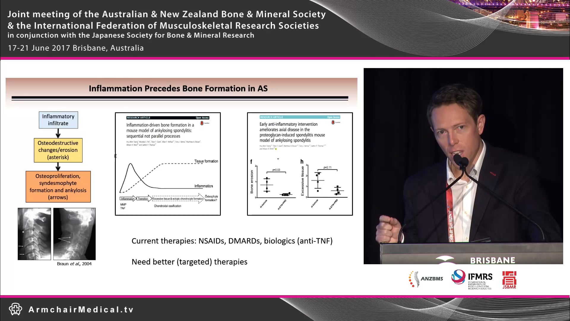 Emerging concepts in immunopathogenesis of ankylosing spondylitis Dr Tony Kenna