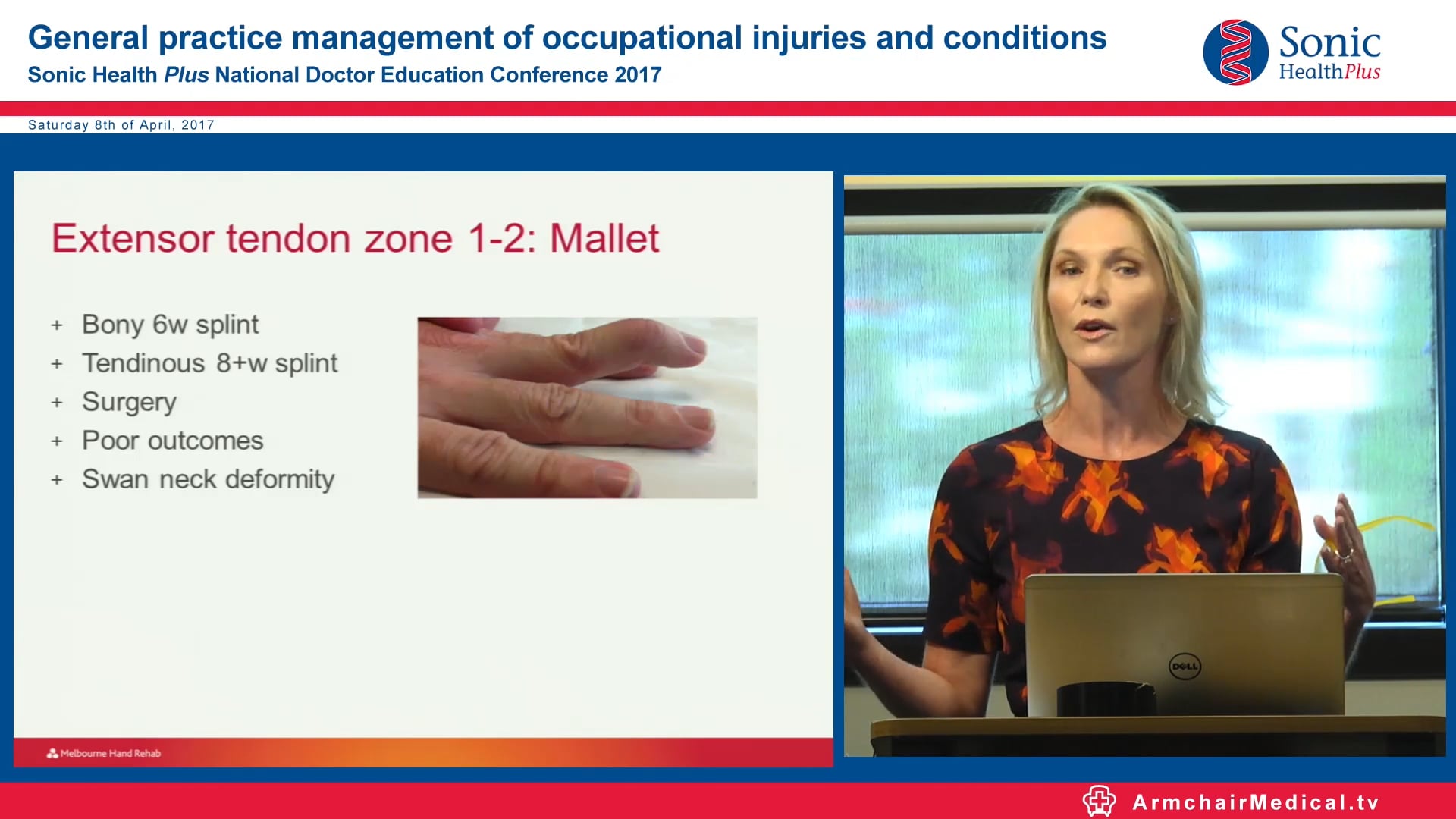 Hand therapy for common hand injuries Karen Fitt