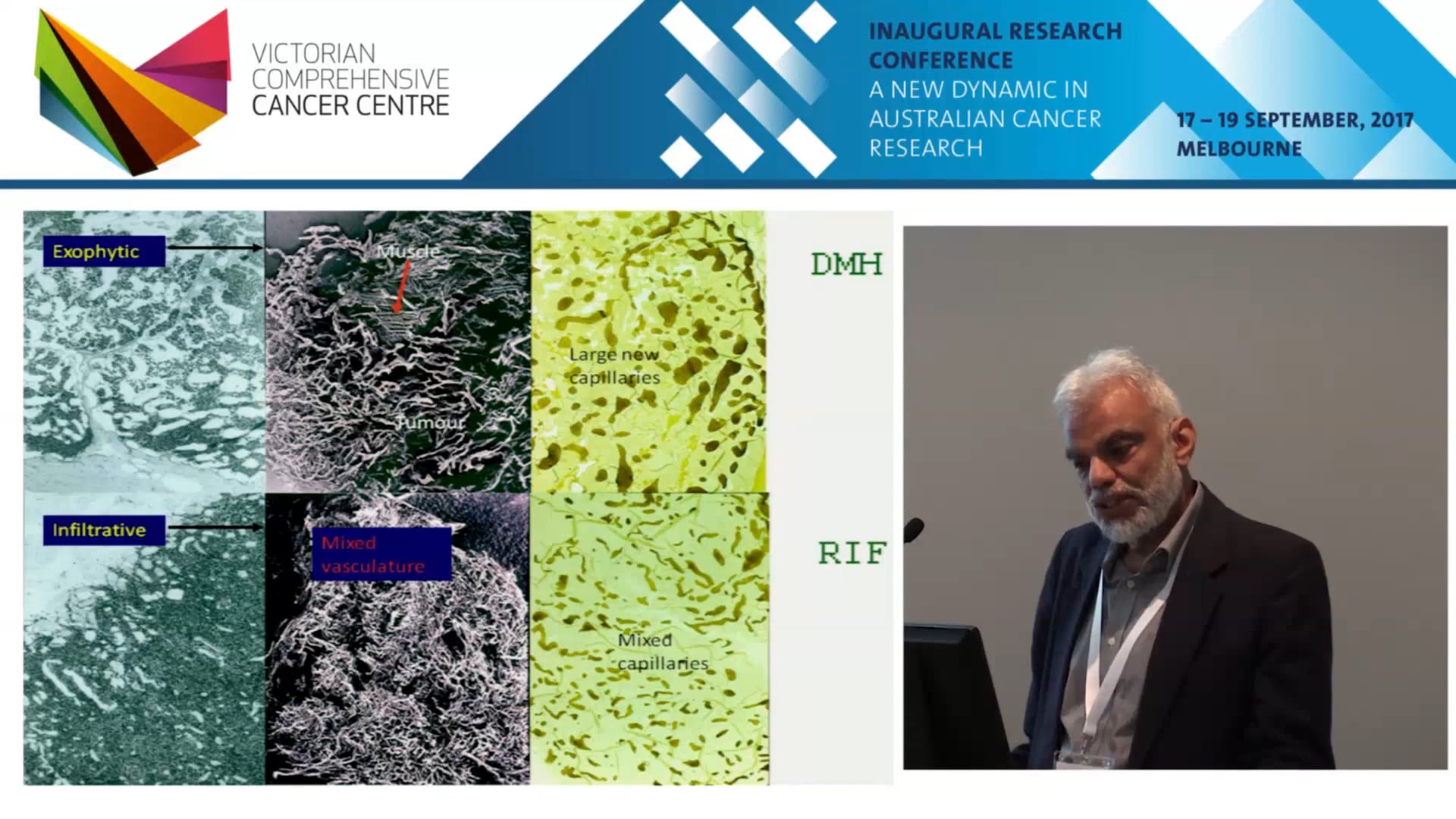 Tumour size, lympho-vascular invasion and metastasis A clinical perspective - Kailash Naryan
