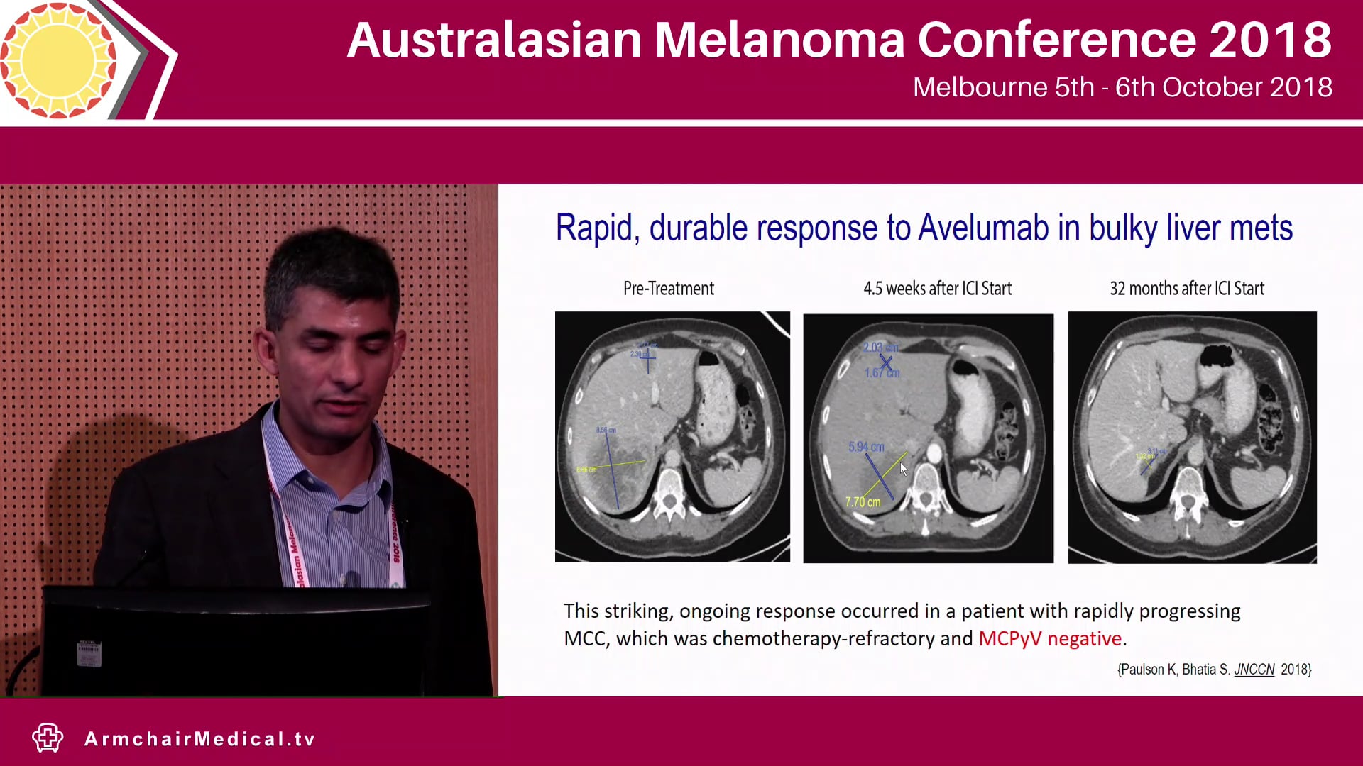 Curing Merkel cell carcinoma Progress and Challenges Shailender Bhatia