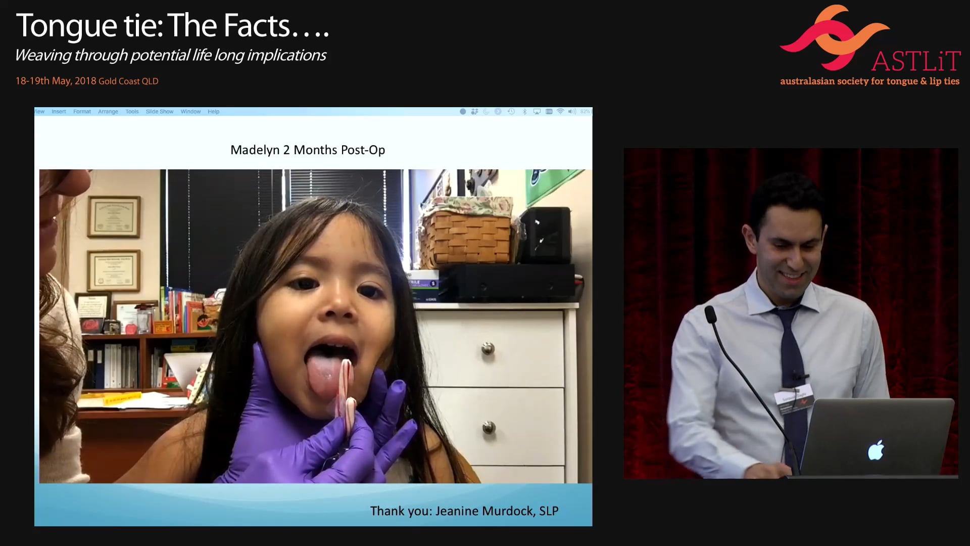 The Impact of Restricted Tongue Mobility (Tongue-Tie) on Sleep-Disordered Breathing Evidence in children and adults Part 2. Soroush Zaghi