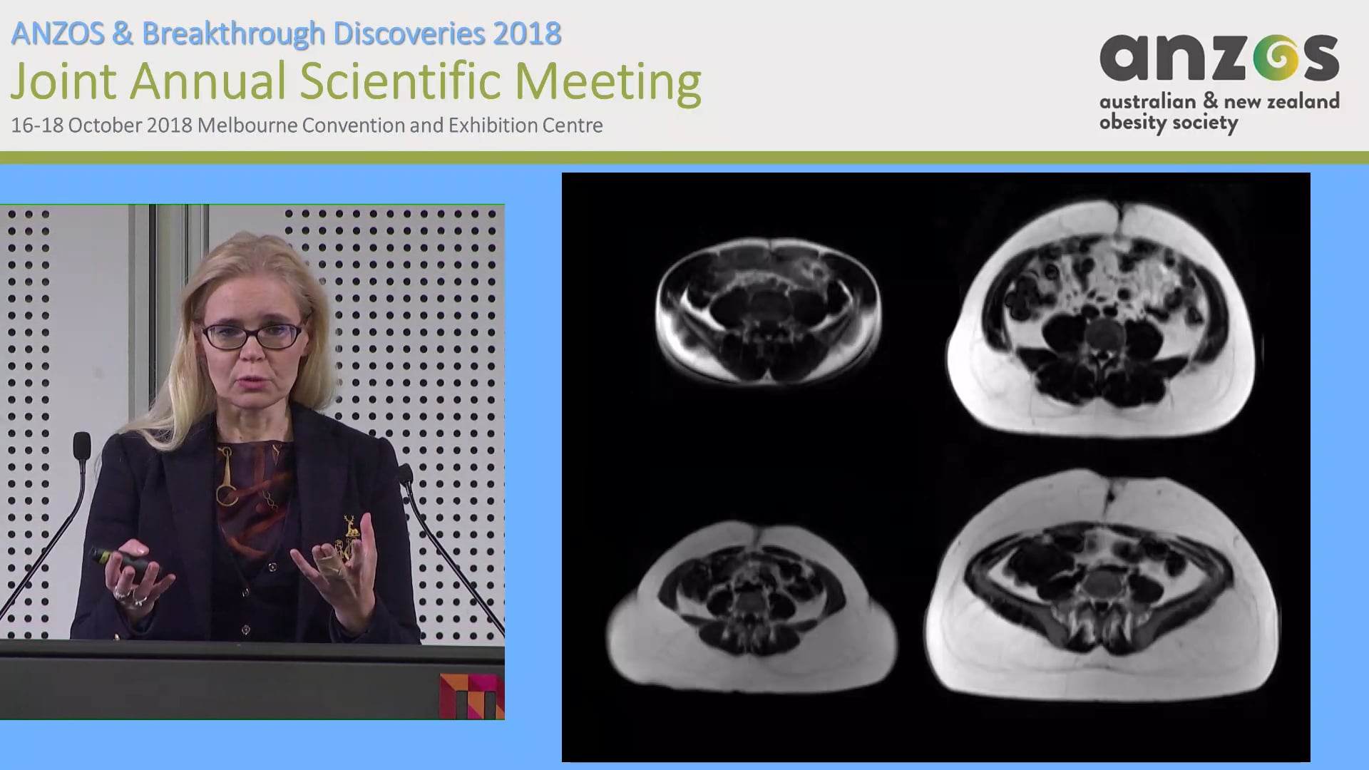 Metabolic effects of acquired obesity - lessons from twin studies - Prof Kirsi Pietilainen