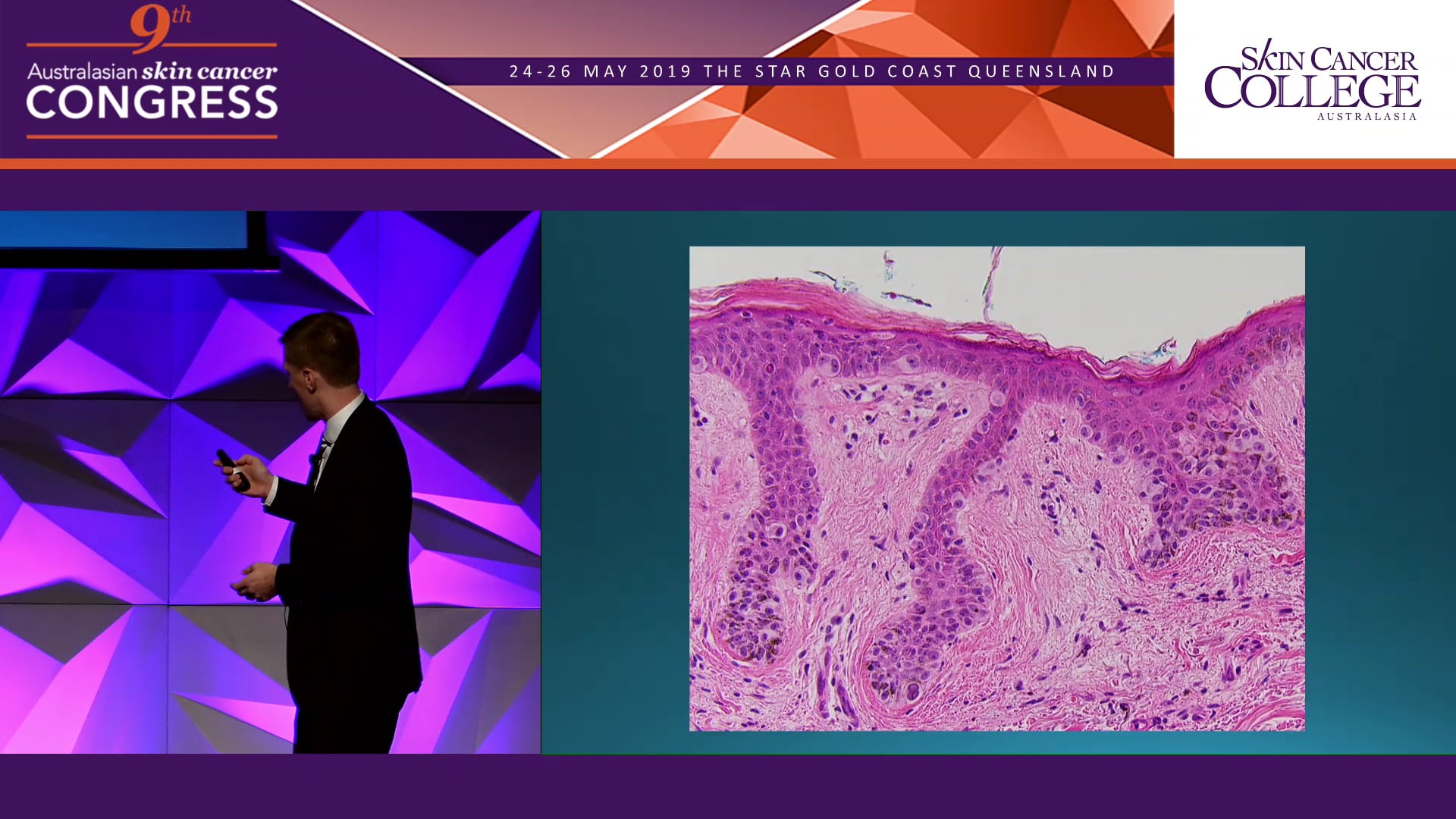 Should pathologists be better at grading melanocytic lesions Dr Blake O'Brien