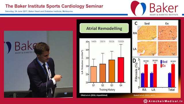 Atrial fibrillation and endurance ath...