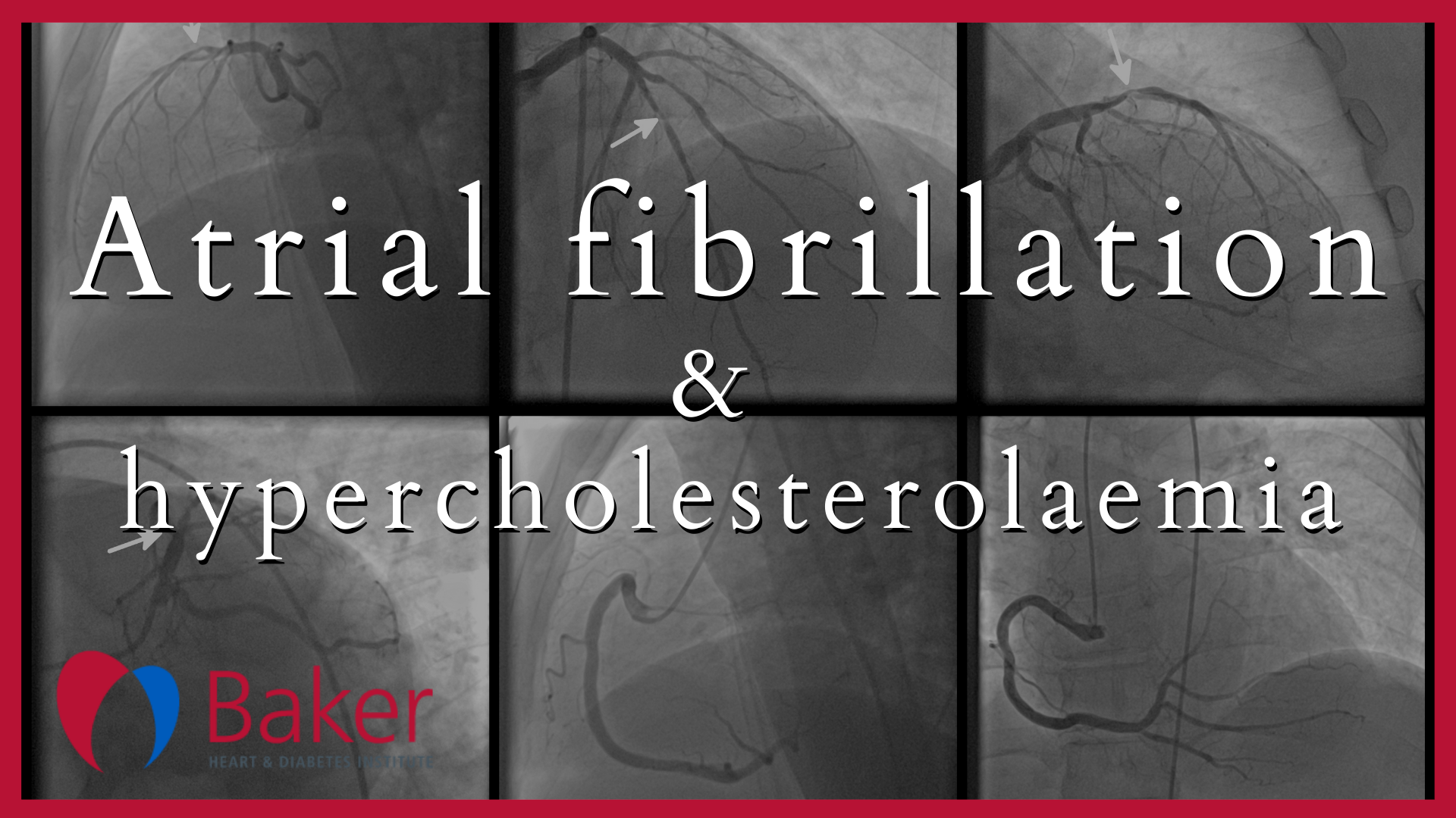 Baker GP Conference Atrial fibrillation