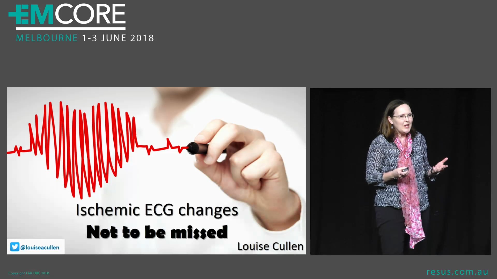 Ischaemic ECG Changes not to be missed Prof Louise Cullen