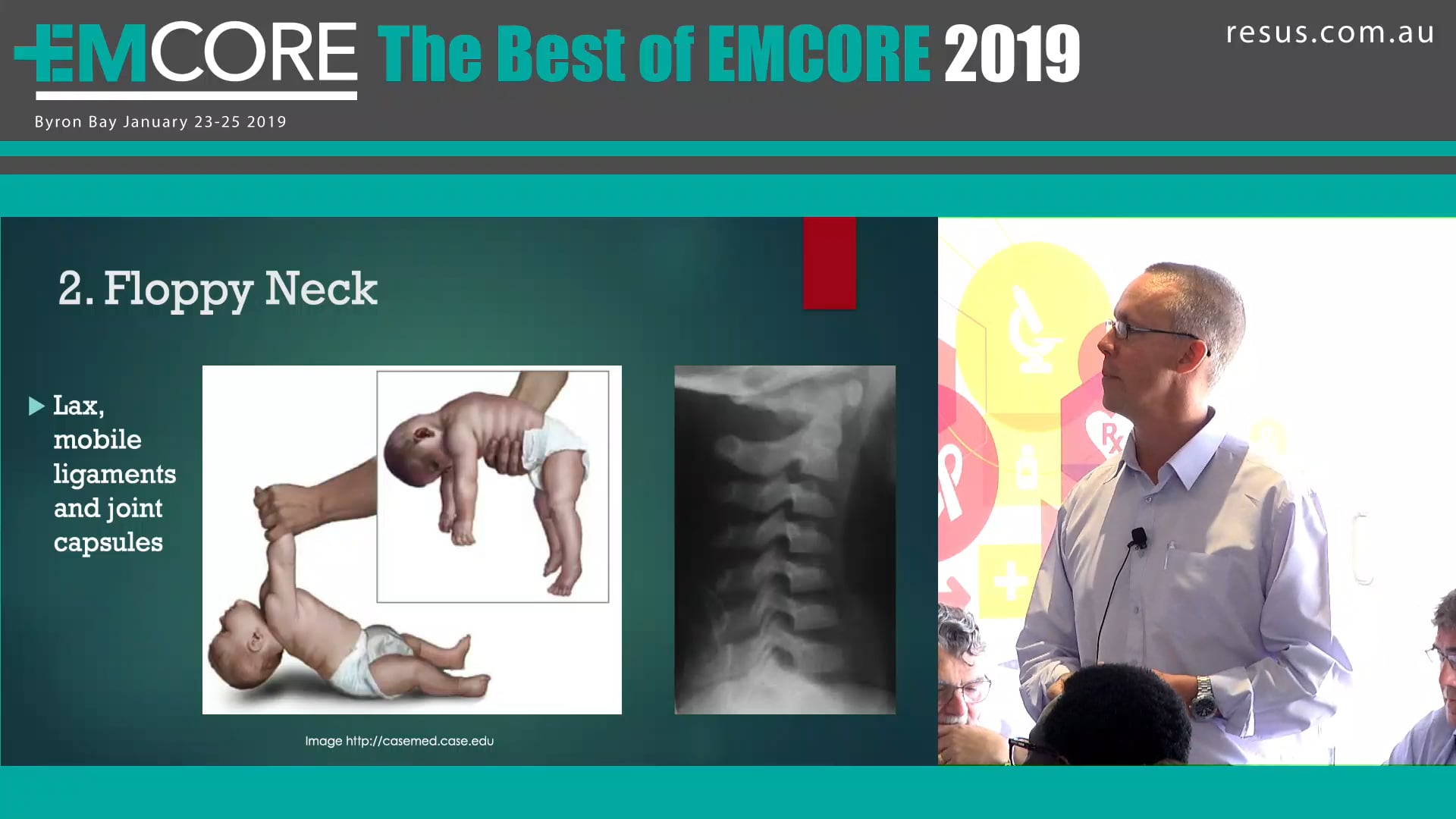 Clearing the C spine in Kids Adam Michaels