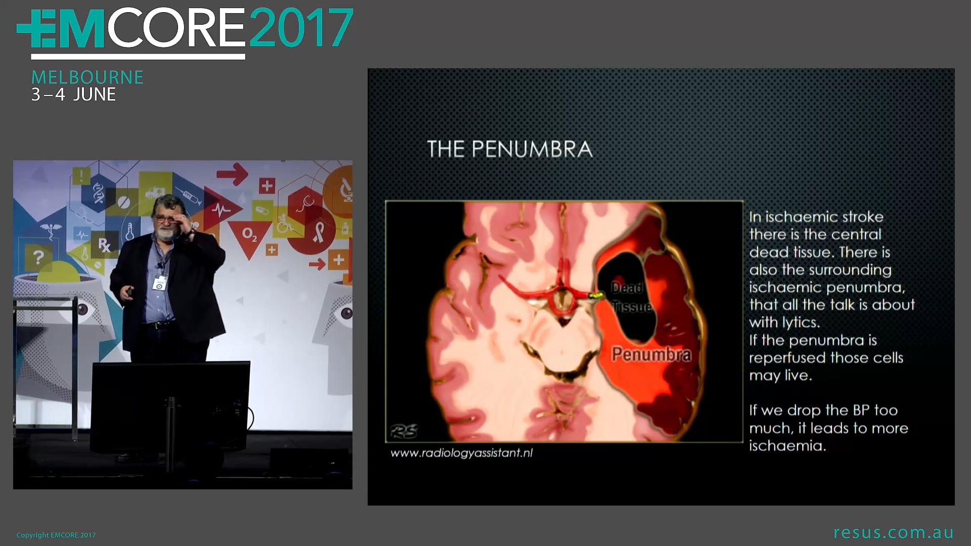 Blood pressure control in intracerebral bleeds Assoc Peter Kas