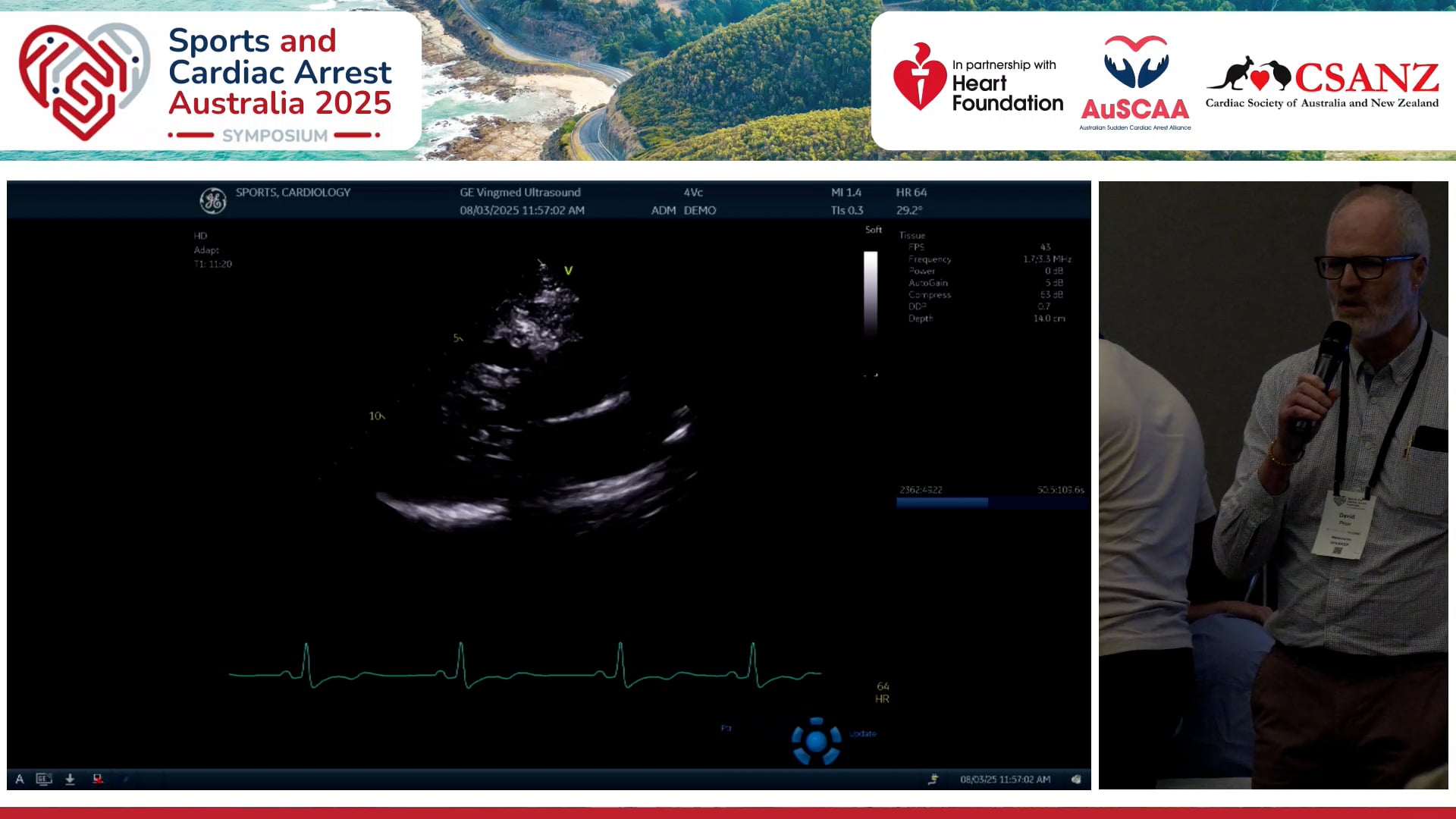 Case - A marathon runner with apical HCM Echocardiogram (Expert commentator D Prior) Cardiopulmonary exercise test (Expert commentator M Haykowsky)