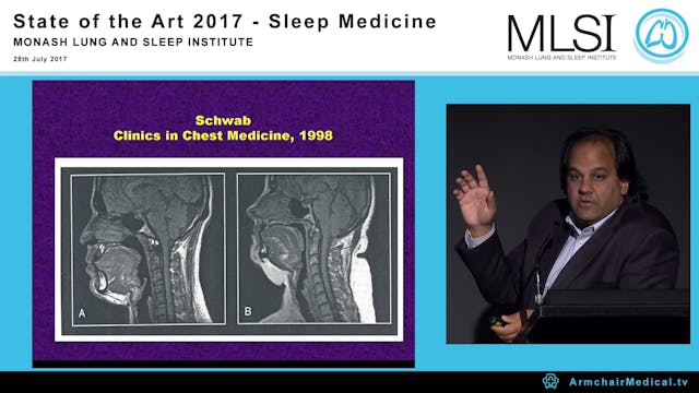 Future of Sleep Apnea Therapy Prof At...