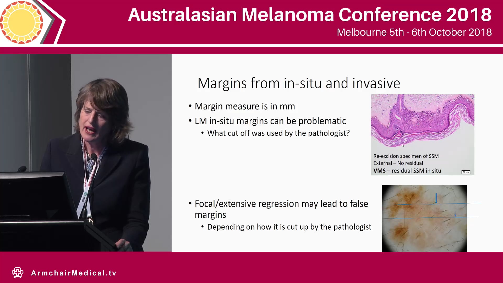 Interpreting the pathology report for optimal management Catriona McLean